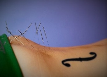 acupuncture