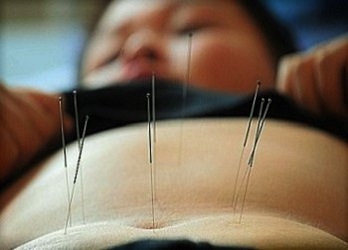 acupuncture